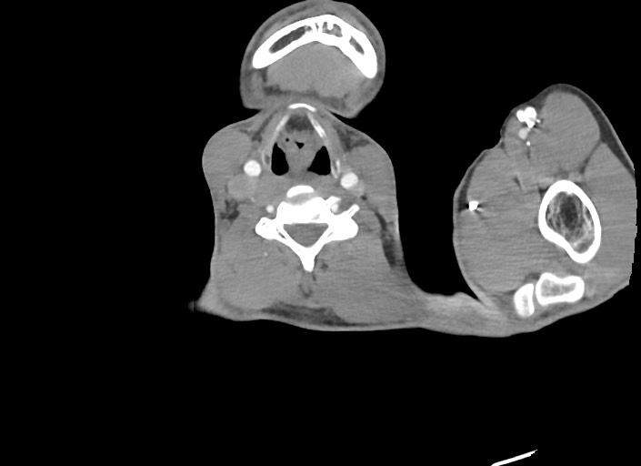 File:Aortic coarctation with aneurysm (Radiopaedia 74818-85828 A 206).jpg