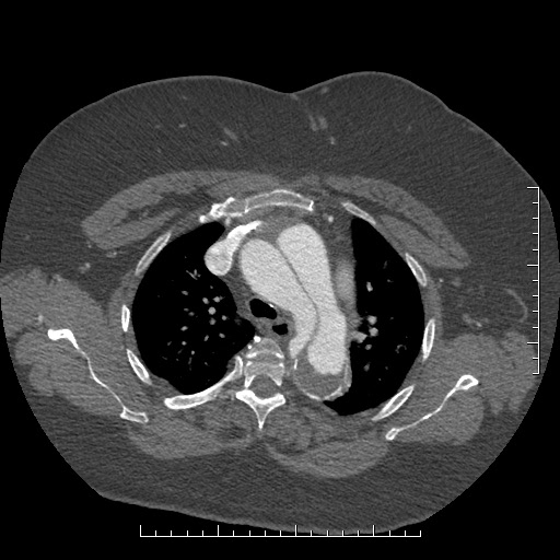 Aortic dissection- Stanford A (Radiopaedia 35729-37268 A 21).jpg
