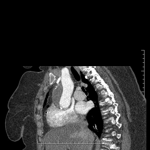File:Aortic dissection- Stanford A (Radiopaedia 35729-37268 D 38).jpg