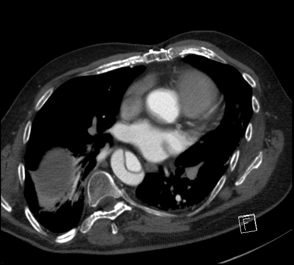 Aortic dissection (CTPA) (Radiopaedia 75506-86750 A 52).jpg
