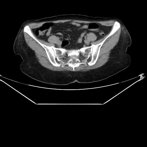 Aortic dissection (Radiopaedia 25350-25604 B 63).jpg