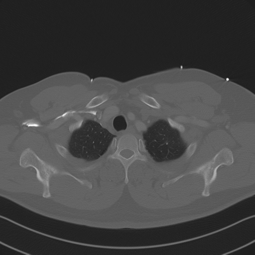 File:Aortic dissection (Radiopaedia 50763-56234 Axial bone window 19).png