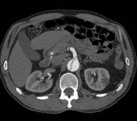 Aortic dissection - Stanford type B (Radiopaedia 73648-84437 A 136).jpg