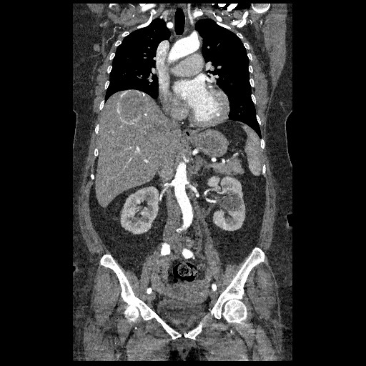 File:Aortic dissection - Stanford type B (Radiopaedia 88281-104910 B 34).jpg