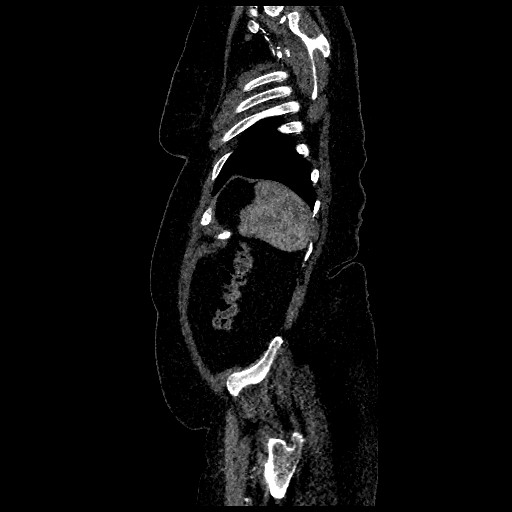 Aortic dissection - Stanford type B (Radiopaedia 88281-104910 C 76).jpg