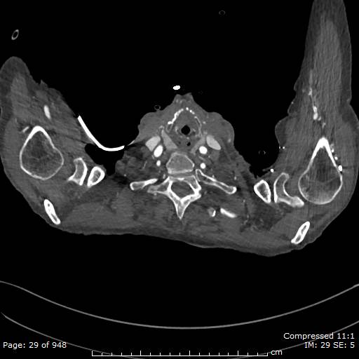 Aortic dissection with extension into aortic arch branches (Radiopaedia 64402-73204 B 29).jpg