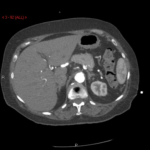 Aortic intramural hematoma (Radiopaedia 27746-28001 A 92).jpg