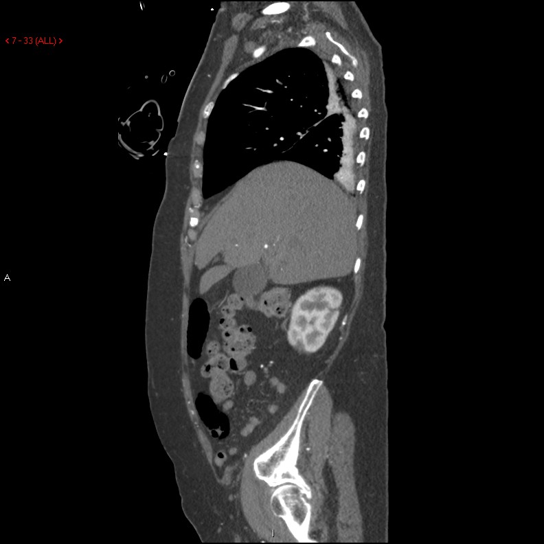 Aortic intramural hematoma (Radiopaedia 27746-28001 C 2).jpg