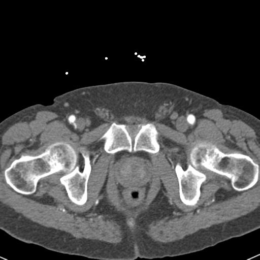 Aortic intramural hematoma (Radiopaedia 31139-31838 B 170).jpg