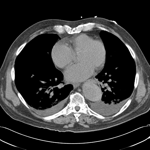 File:Aortic intramural hematoma (Radiopaedia 34260-35540 Axial non-contrast 40).png
