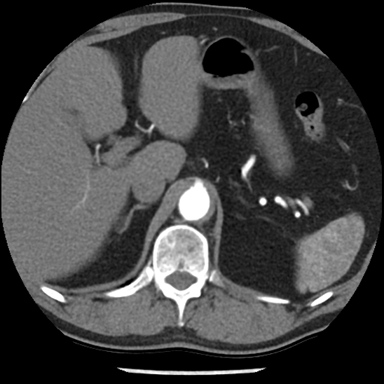 Aortic intramural hematoma (type B) (Radiopaedia 79323-92387 B 56).jpg