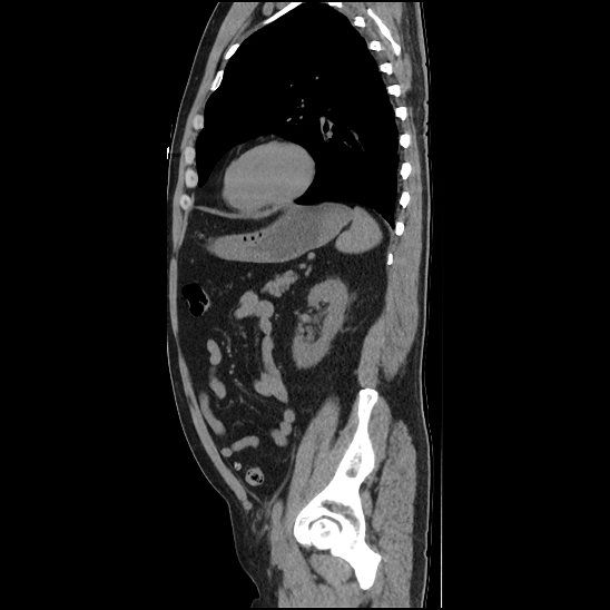 Aortic intramural hematoma (type B) (Radiopaedia 79323-92387 G 39).jpg