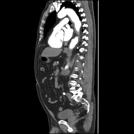 Aortic intramural hematoma (type B) (Radiopaedia 79323-92387 H 30).jpg