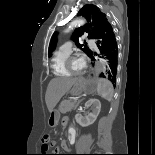 File:Aortic intramural hematoma from penetrating atherosclerotic ulcer (Radiopaedia 31137-31836 B 9).jpg