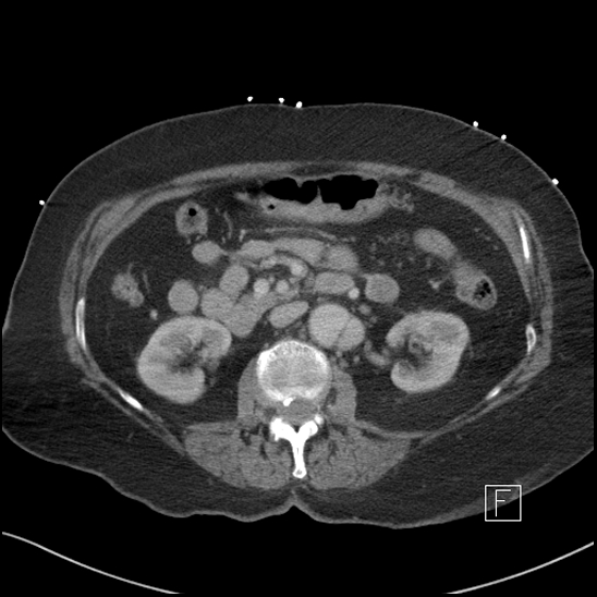 Aortic intramural hematoma with dissection and intramural blood pool (Radiopaedia 77373-89491 E 31).jpg