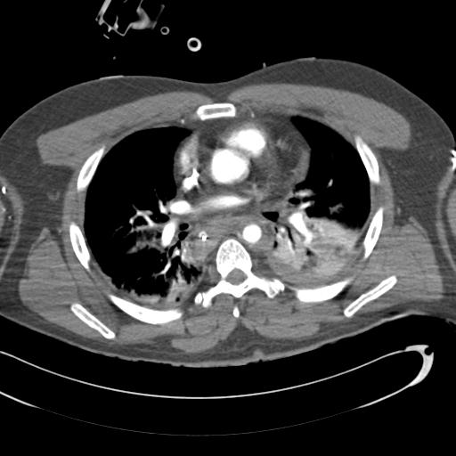 Aortic transection, diaphragmatic rupture and hemoperitoneum in a complex multitrauma patient (Radiopaedia 31701-32622 A 44).jpg