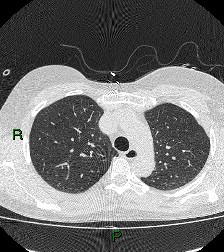 File:Aortic valve endocarditis (Radiopaedia 87209-103485 Axial lung window 31).jpg