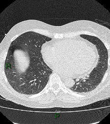 File:Aortic valve endocarditis (Radiopaedia 87209-103485 Axial lung window 67).jpg