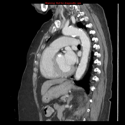 File:Aortic valve stenosis (Radiopaedia 14480-14423 B 8).jpg