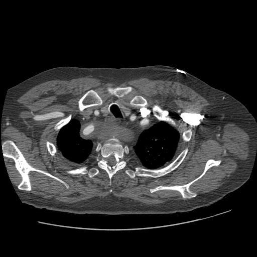 File:Aorto-coronary bypass graft aneurysms (Radiopaedia 40562-43157 A 19).png