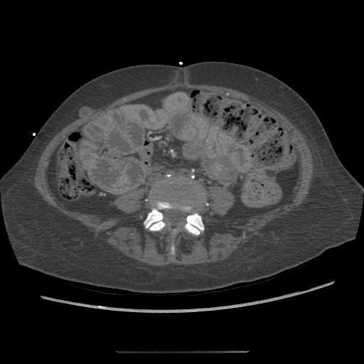 Aorto-duodenal fistula (Radiopaedia 25668-25850 A 50).jpg