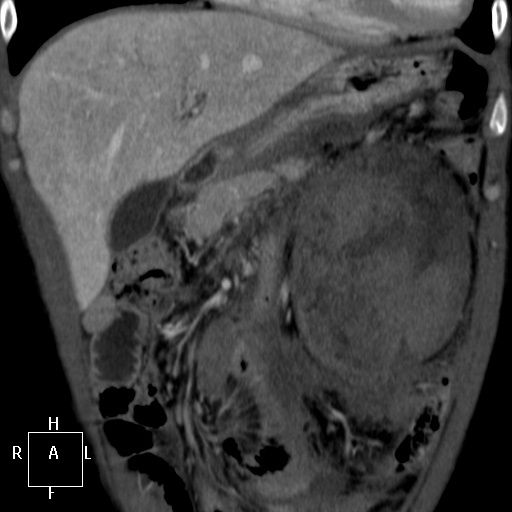 File:Aorto-left renal vein fistula (Radiopaedia 45534-49628 B 9).jpg