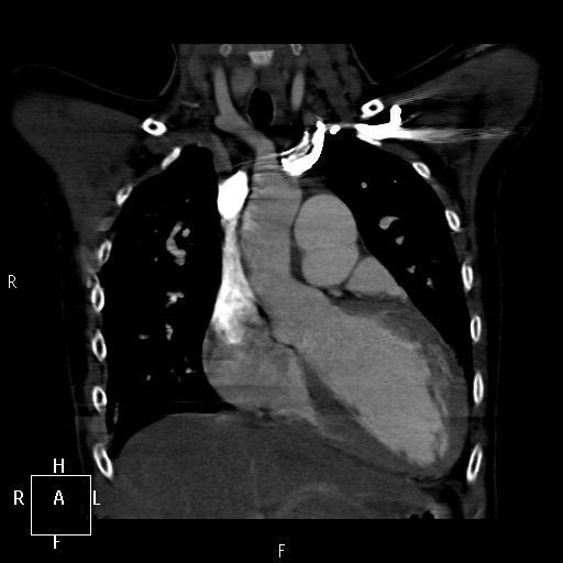File:Aortopulmonary septal defect (Radiopaedia 41990-45013 Coronal C+ CTPA 19).jpg