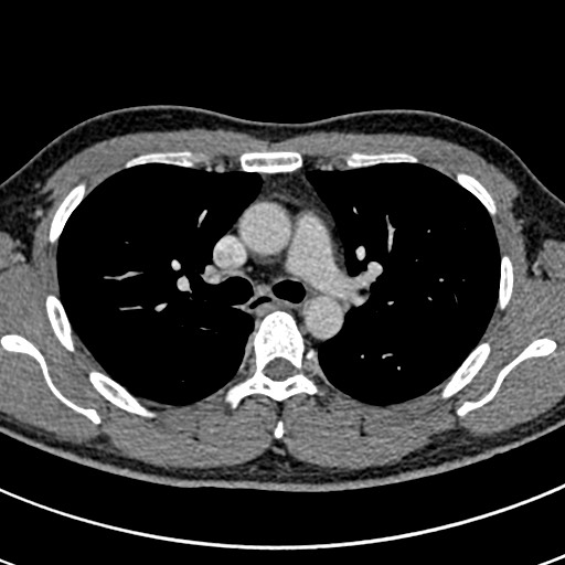 Apical lung mass mimic - neurogenic tumor (Radiopaedia 59918-67521 A 32).jpg