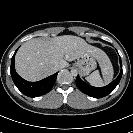 Apical lung mass mimic - neurogenic tumor (Radiopaedia 59918-67521 A 73).jpg