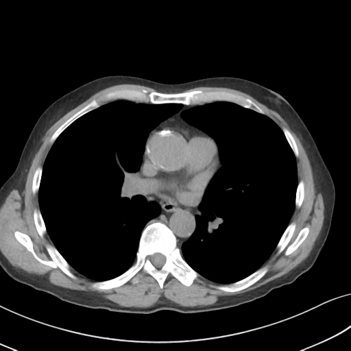 Apical pulmonary metastasis (Radiopaedia 46338-50754 B 33).png