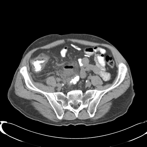 File:Appendiceal abscesses (Radiopaedia 50999-56542 Axial non-contrast 59).png