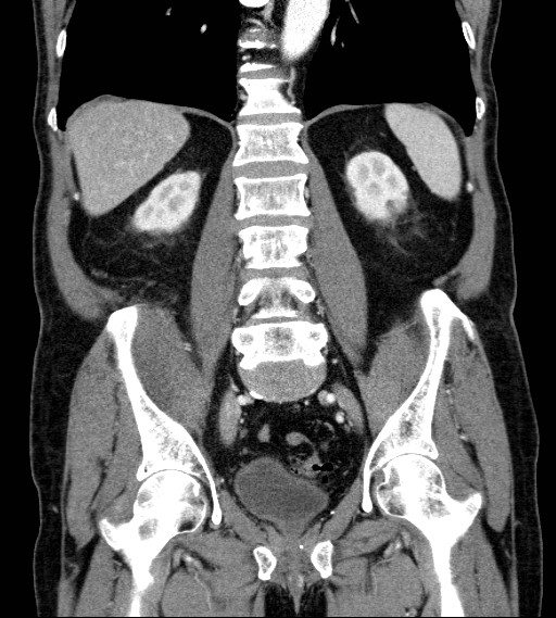 File:Appendiceal adenocarcinoma complicated by retroperitoneal abscess (Radiopaedia 58007-65039 A 58).jpg