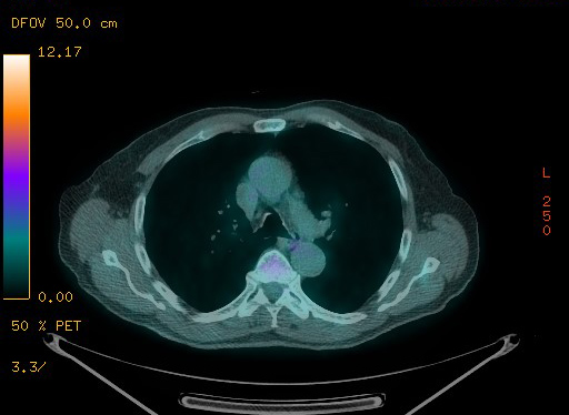 Appendiceal adenocarcinoma complicated by retroperitoneal abscess (Radiopaedia 58007-65041 Axial PET-CT 59).jpg