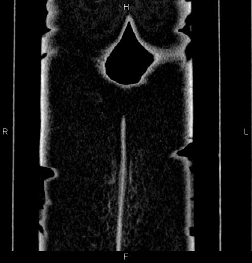 Appendiceal mucocele (Radiopaedia 83147-97518 C 68).jpg