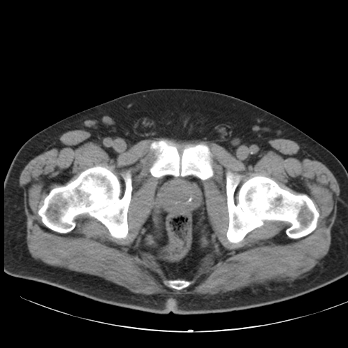 Appendicitis and giant appendicolith (Radiopaedia 80251-93588 Axial non-contrast 58).jpg