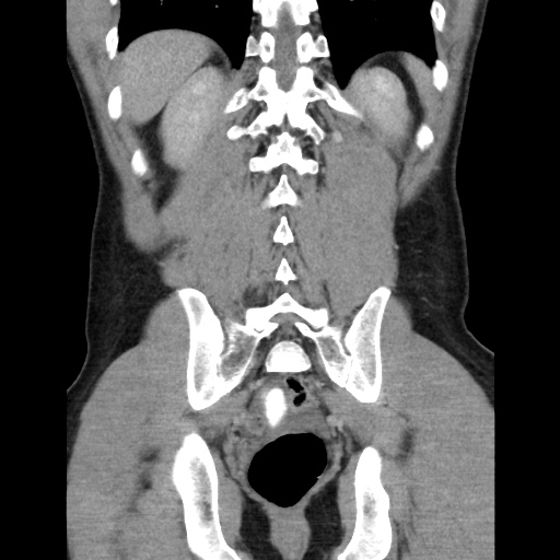 File:Appendicitis complicated by post-operative collection (Radiopaedia 35595-37113 B 42).jpg