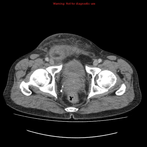 File:Appendicitis mass in inguinal hernia (Radiopaedia 26858-27029 A 27).jpg