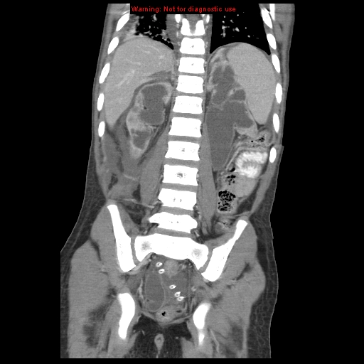 Appendicitis with phlegmon (Radiopaedia 9358-10046 B 50).jpg