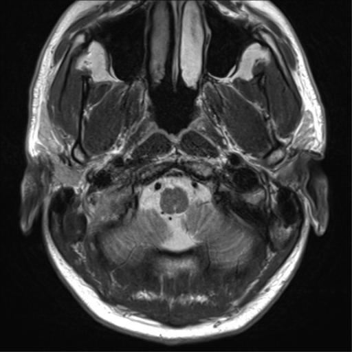 File:Arachnoid cyst - cerebellopontine angle (Radiopaedia 59689-67083 Axial T2 7).png