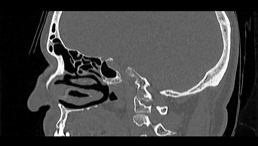 Arcuate foramen (Radiopaedia 89833-106944 Sagittal bone window 35).jpg