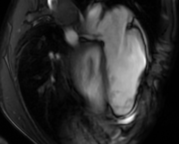 Arrhythmogenic right ventricular cardiomyopathy (Radiopaedia 69564-79464 4ch cine 115).jpg