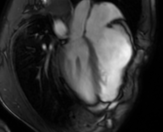 Arrhythmogenic right ventricular cardiomyopathy (Radiopaedia 69564-79464 4ch cine 84).jpg