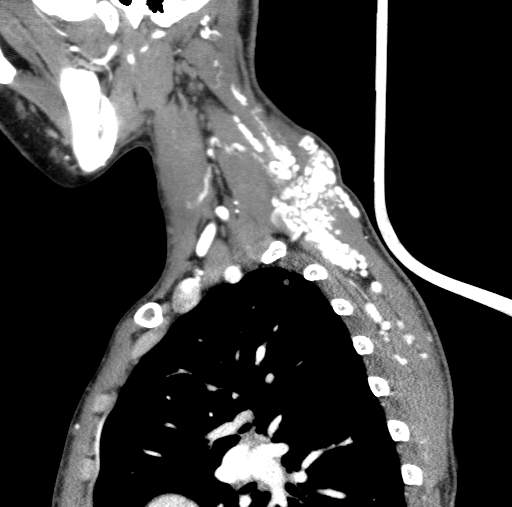 File:Arteriovenous malformation of the neck (Radiopaedia 53935-60062 C 26).jpg