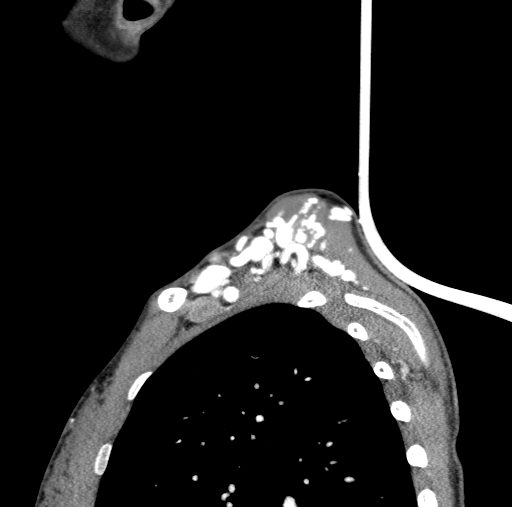 Arteriovenous malformation of the neck (Radiopaedia 53935-60062 C 4).jpg