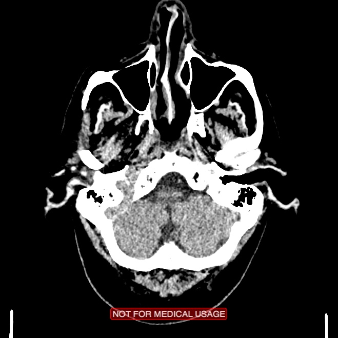 Artery of Percheron infarction (Radiopaedia 28679-28967 Axial non-contrast 17).jpg