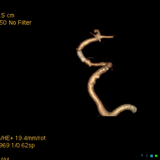 File:Artifactual basilar artery stenosis due to metallic stent (Radiopaedia 31206-31923 C 4).jpg