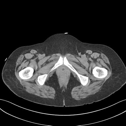 File:Ascending cholangitis (Radiopaedia 39068-41253 Axial non-contrast 72).png