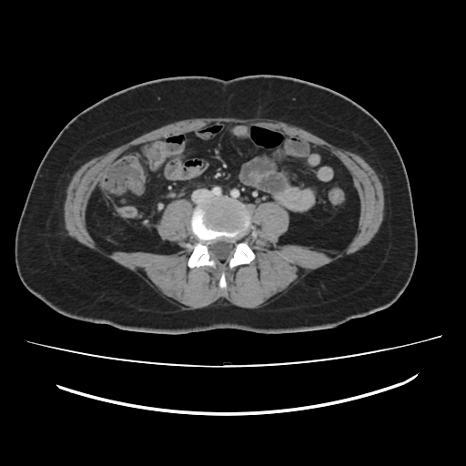 File:Ascending retrocecal appendicitis with liver abscesses (Radiopaedia 60066-67615 B 56).jpg