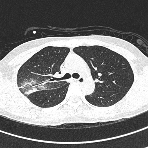 File:Aspergilloma (Radiopaedia 26223-26347 Axial lung window 29).jpg