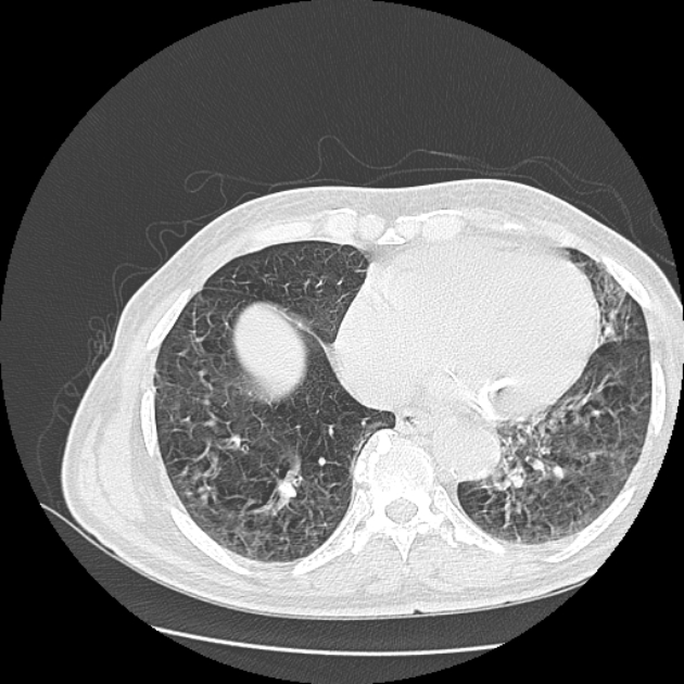 Aspergilloma (Radiopaedia 44592-48327 Axial lung window 66).jpg